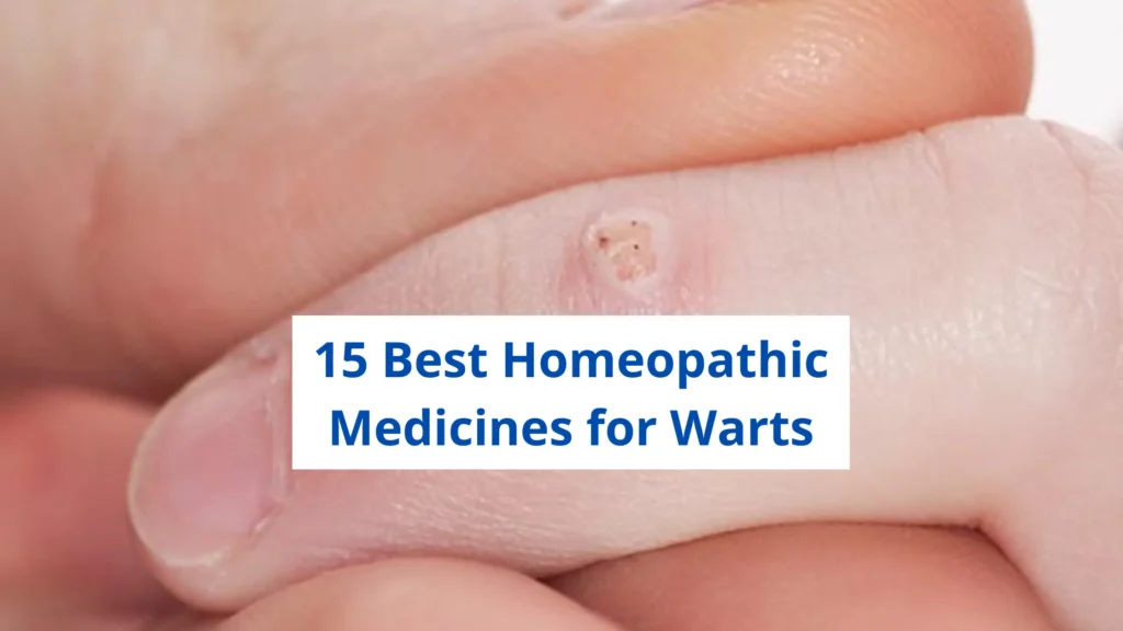15 Best Homeopathic Medicine For Warts