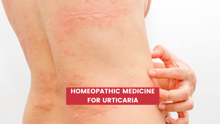 Top 10 Homeopathic Medicine for Urticaria