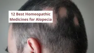 12 Best Homeopathic Medicine for Alopecia Areata