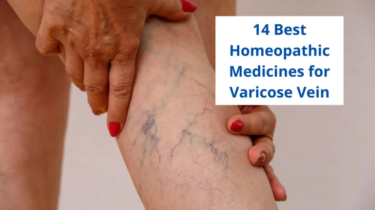 15 Best Homeopathic Medicine For Varicose Veins